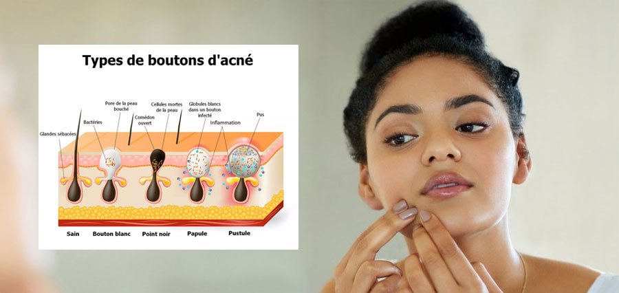 Traitement acne : Achat de produits pour traiter l'acné en ligne
